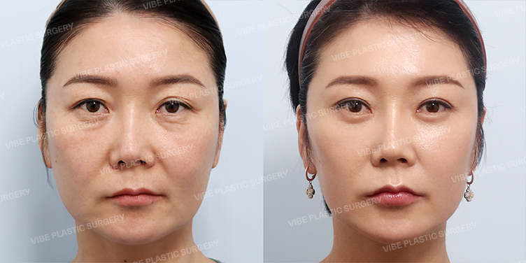 #내시경이마거상 #절개눈매교정 #하안검 #중안면거상 #미니스미스거상 #목거상