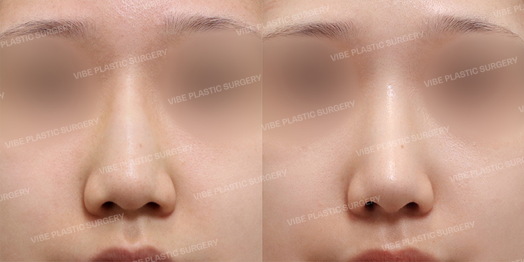 #무보형물코성형 #코끝 #매부리 #절골 #긴코 #복코