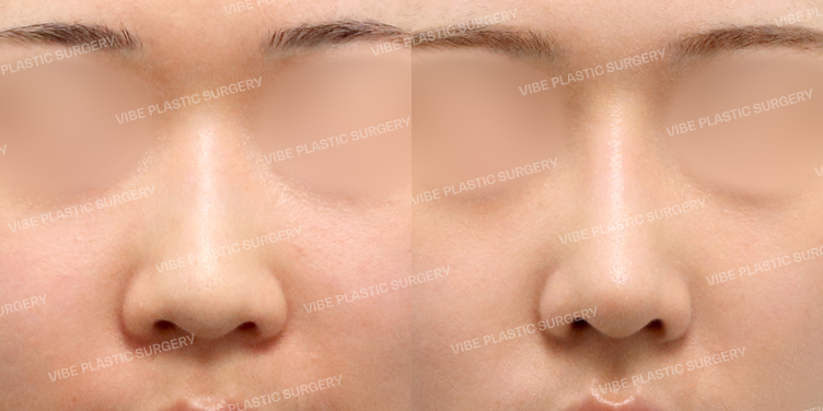 #콧대 #코끝 #복코 #매부리 #긴코