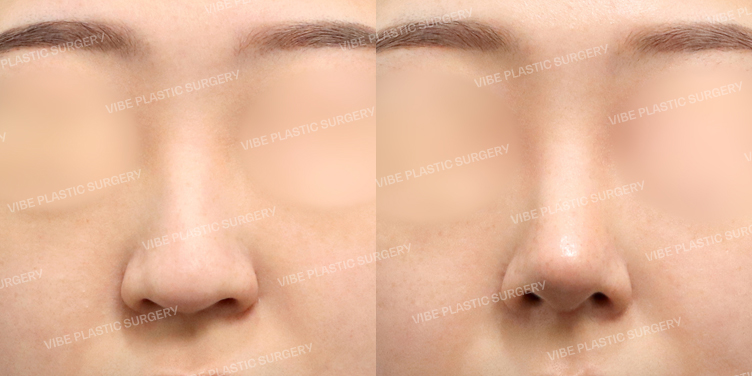 #무보형물코성형 #기증늑 #매부리 #긴코 #복코