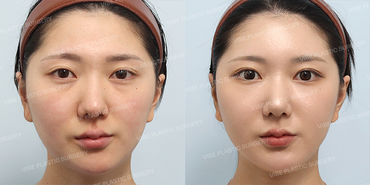 #무보형물코성형 #매부리 #복코 #긴코 #비순각교정 #얼굴지방이식 #눈밑지방재배치