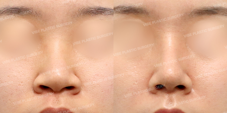 #콧대 #코끝 #자가늑 #복코 #비순각교정