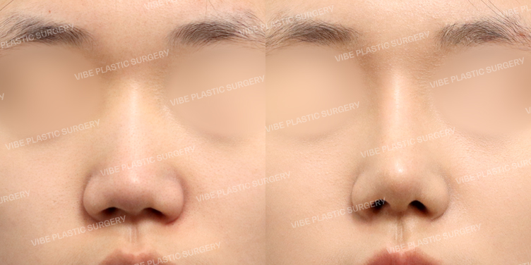 #콧대 #코끝 #기증늑 #복코 #비주교정