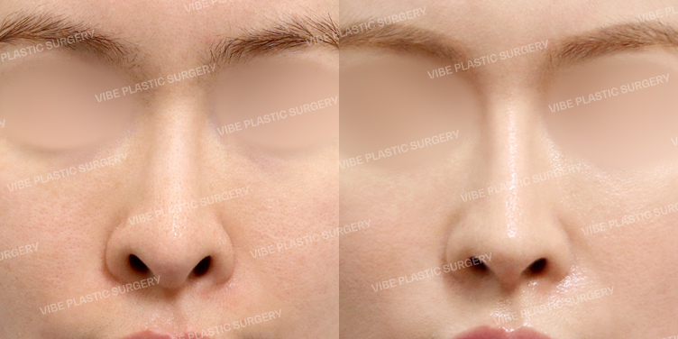 #코재수술 #기증늑 #비공내리기 #긴코