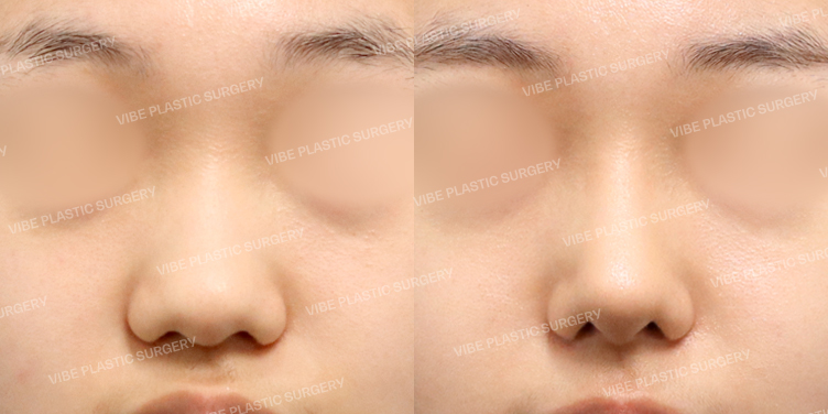 #콧대 #코끝 #복코 #긴코 #비순각교정