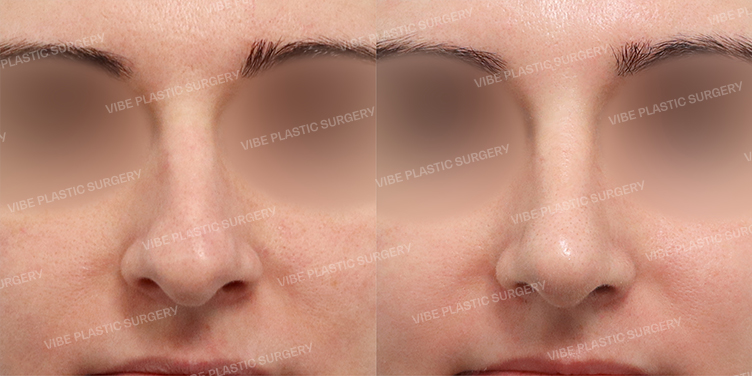 #매부리 #비중격만곡증교정 #하비갑개축소 #비중격