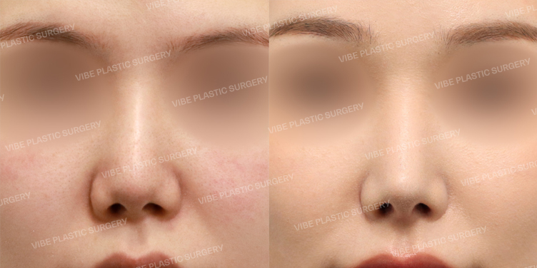 #코재수술 #콧대 #코끝 #자가늑 #찝힌코 #짧은코 #비순각교정