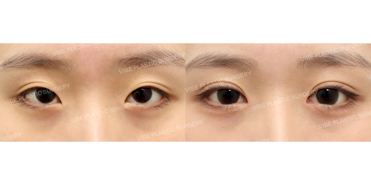 #부분절개눈매교정 #앞트임 #윗트임