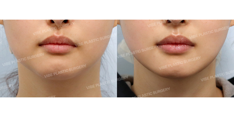 #초음파지방흡입(이중턱, 턱라인) #실리프팅