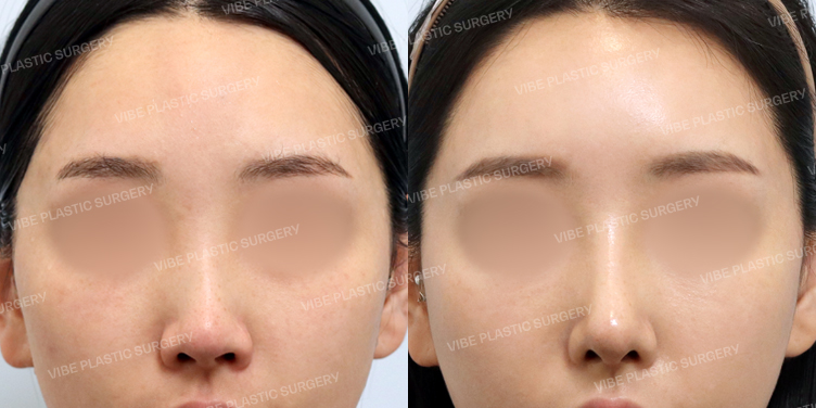 #지방이식(이마,관자) #콧대 #코끝 #자가늑 #이물질제거 #비순각교정 #휜코 #절골 #기능코