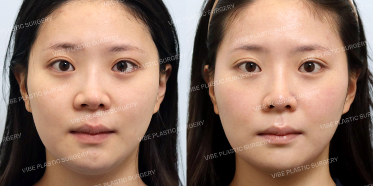 #코재수술 #콧볼축소 #휜코 #자가늑