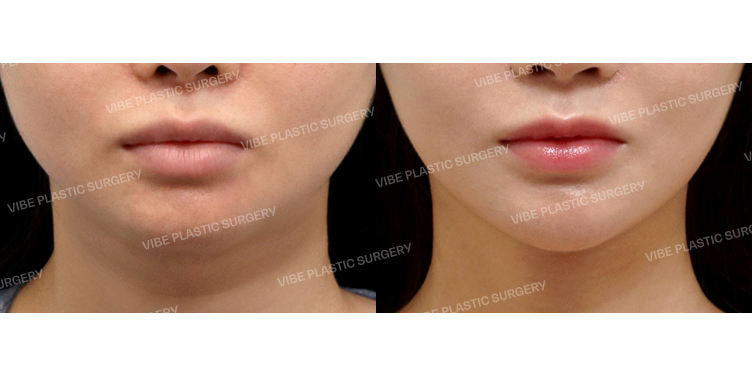 #초음파지방흡입(이중턱,턱라인,팔자위) #목거상(이중턱근육묶기) #실리프팅 #슈링크 #턱끝필러 #사각턱보톡스