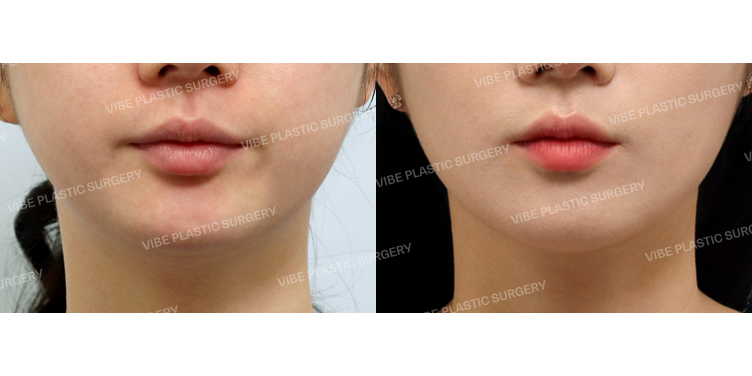 #심부볼지방제거