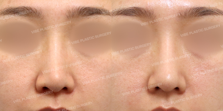 #코재수술 #비순각교정 #긴코 #비중격 #기증늑