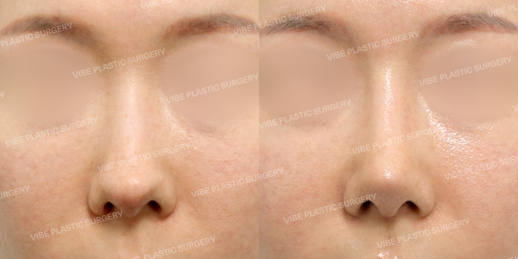 #코재수술 #자가늑 #비중격 #비주교정