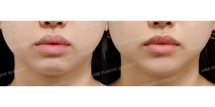 #지방이식(앞턱)