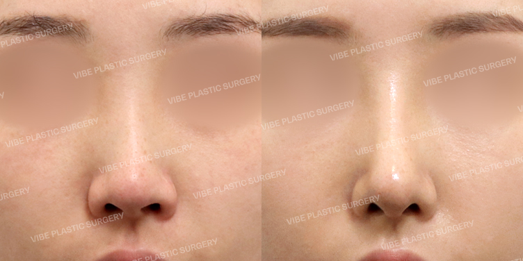 #콧대 #코끝 #자가늑 #이물질제거 #비순각교정 #휜코 #절골 #기능코