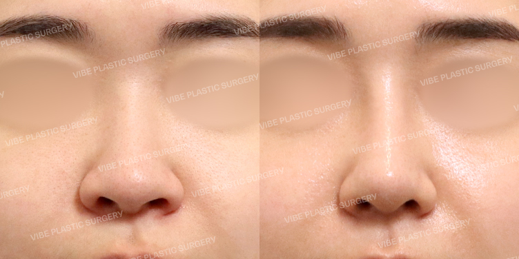 #콧대 #코끝 #비중격 #기증늑 #복코 #긴코 #이물질제거