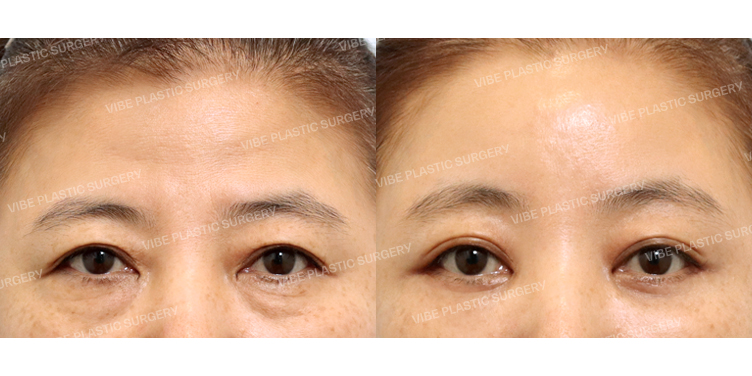 #내시경이마거상 #하안검