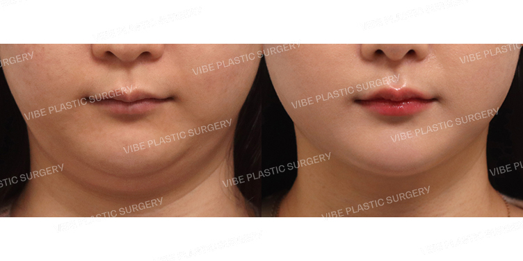 #초음파지방흡입(이중턱,턱라인)