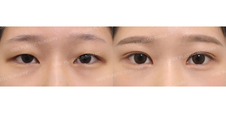 #부분절개쌍꺼풀 #윗트임