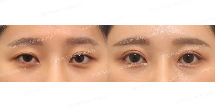 #절개눈매교정 #뒤트임 #밑트임