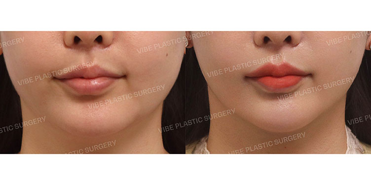 #초음파지방흡입(이중턱,턱라인)