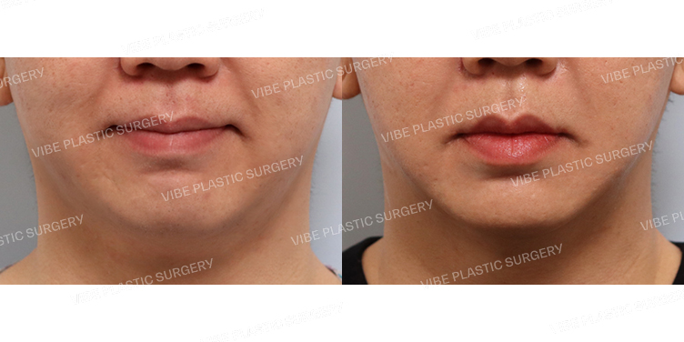 #실리프팅(이중턱,팔자) #초음파지방흡입(이중턱,팔자위)