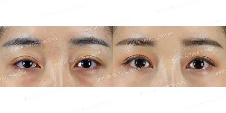 #비절개눈매교정