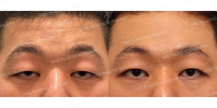 #내시경이마거상 #절개눈매교정