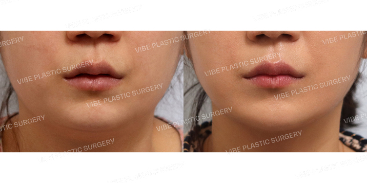 #초음파지방흡입(이중턱,턱라인)