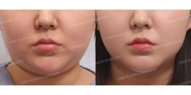 #이중턱실리프팅 #초음파지방흡입(이중턱,턱라인,앞볼) #침샘보톡스