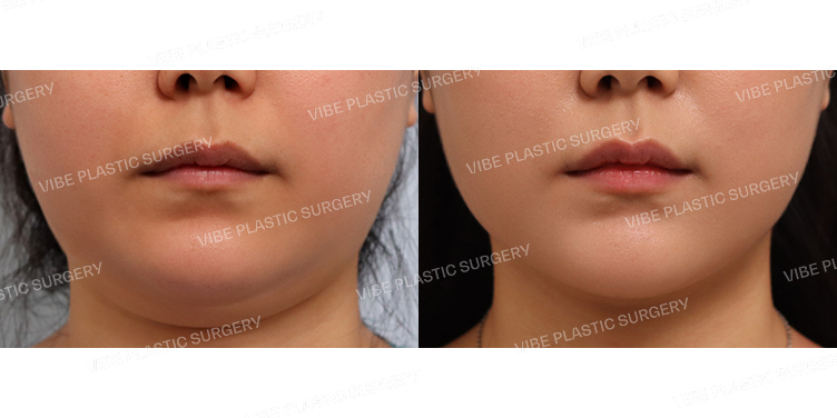 #초음파지방흡입(이중턱,턱라인)