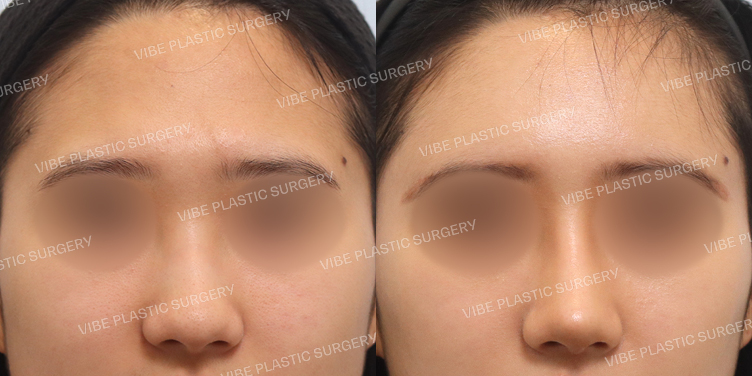 #이마지방이식 #매부리코 #긴코