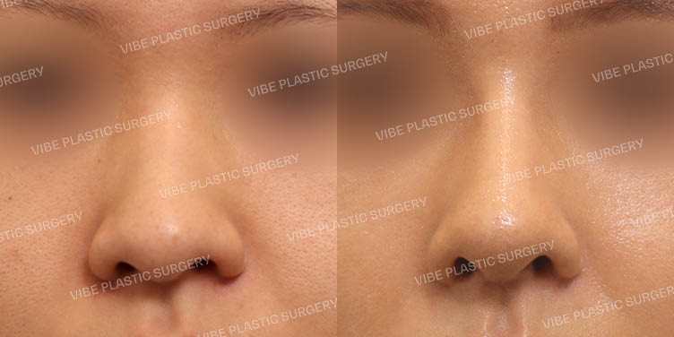 #매부리코 #긴코 #휜코 #복코