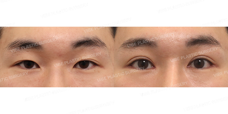 #절개눈매교정(재수술) #윗트임 #뒤트임