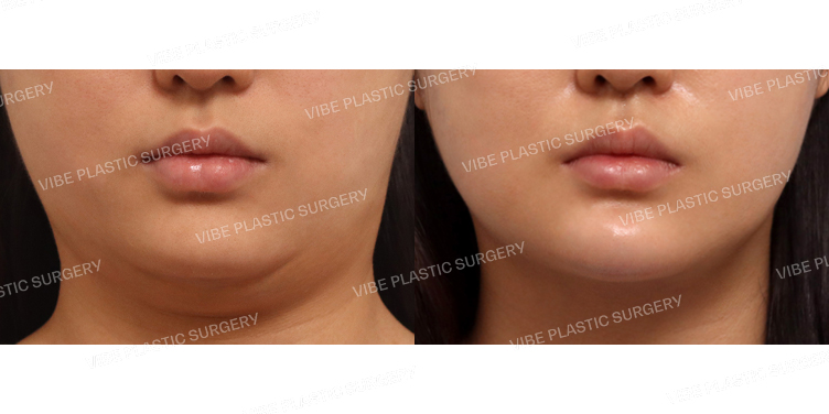 #초음파지방흡입(이중턱)