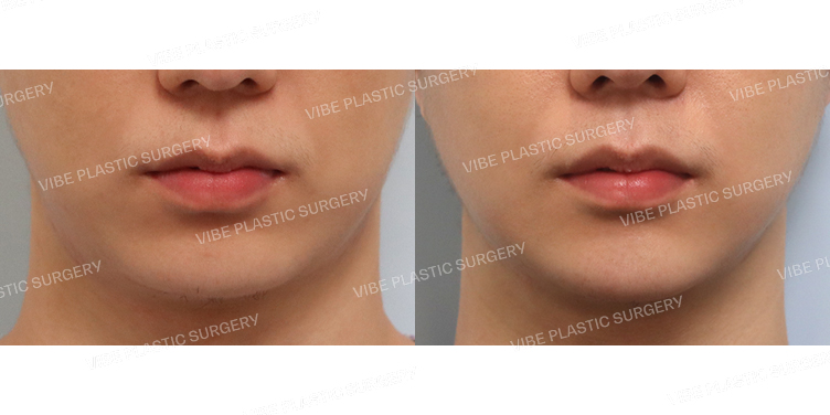 #초음파지방흡입(이중턱,턱라인)