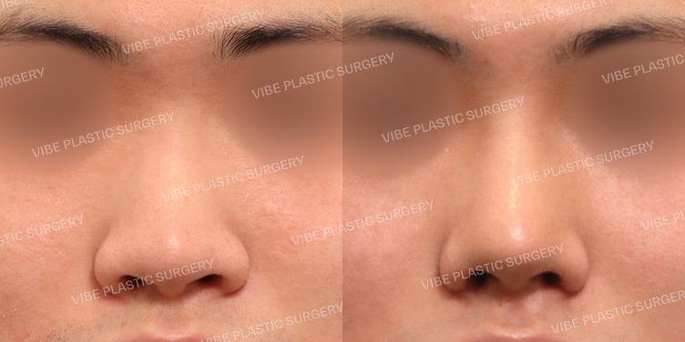 #낮은코 #매부리코 #콧볼축소