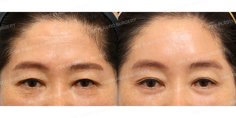 #눈재수술 #자연유착 #하안검 #내시경이마거상