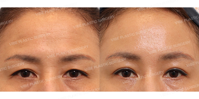 #내시경이마거상 #자연유착