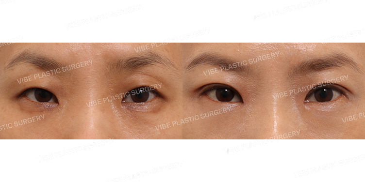 #비절개눈매교정 #앞트임