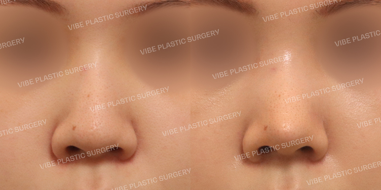 #무보형물 #매부리코 #긴코 #복코