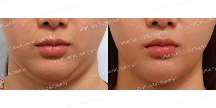 #이중턱&턱라인 지방흡입