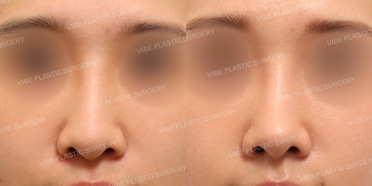 #코재수술 #보형물교체 #복코 #긴코 #코끝