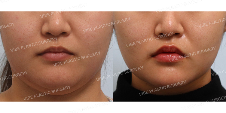 #초음파지방흡입(이중턱&턱라인)