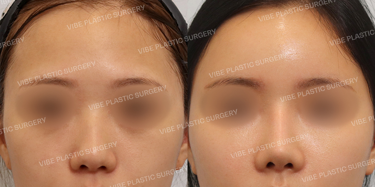 #낮은코 #매부리코 #복코 #이마지방이식