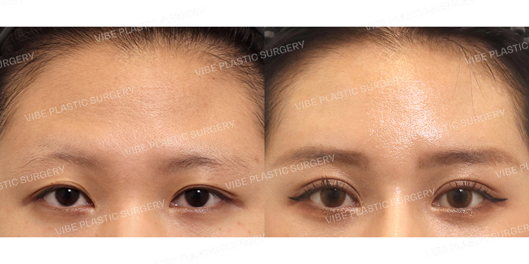 #내시경이마거상 #절개쌍꺼풀(재수술)