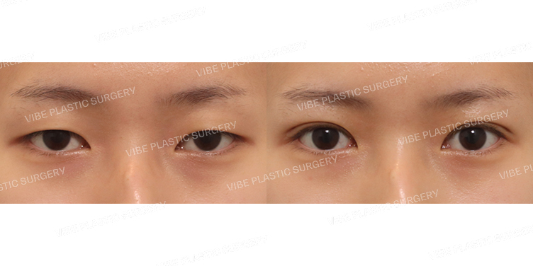 #비절개눈매교정