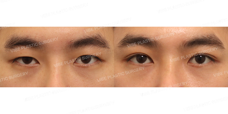 #절개쌍꺼풀(재수술)